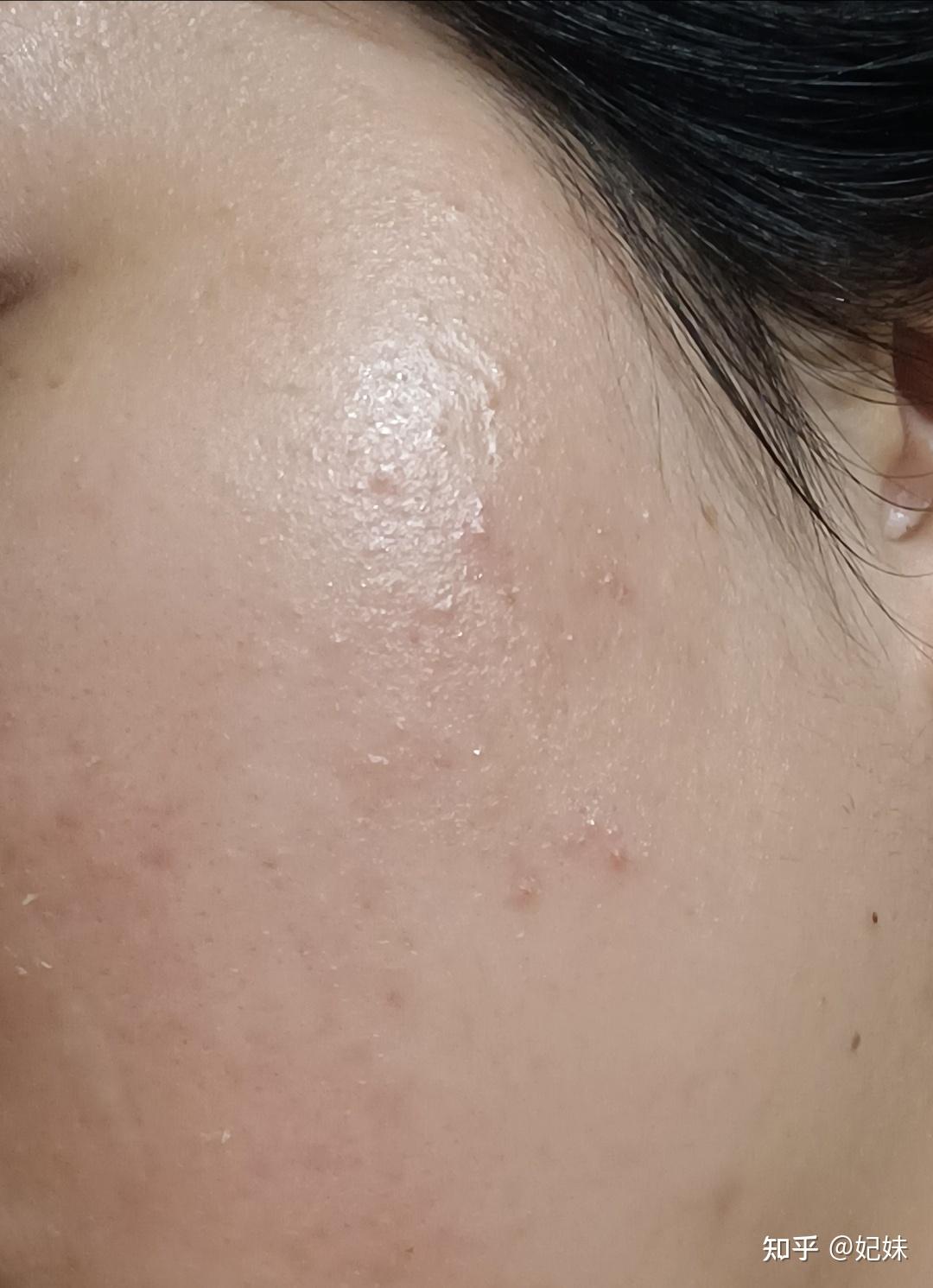 为什么脸上有很多小疙瘩