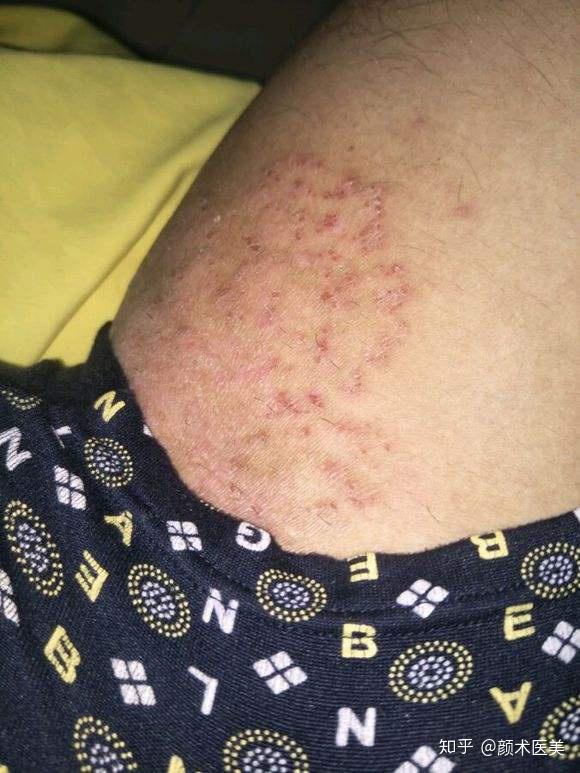 屁屁烂了能涂维生素e吗