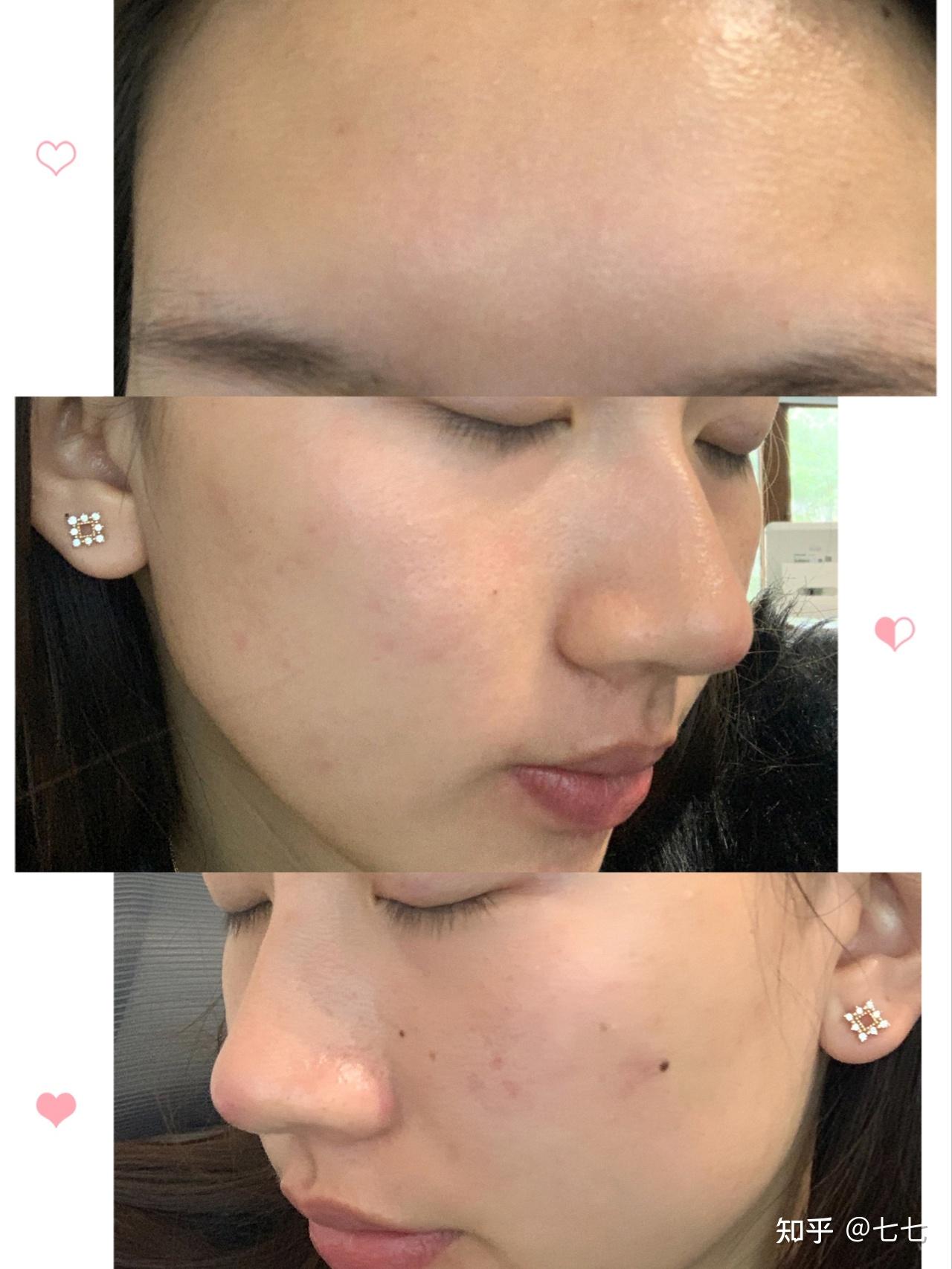 如何有效淡化脸上的痘印?用去痘印产品是智商税吗?盘点那些真正有用的去痘印产品! - 知乎