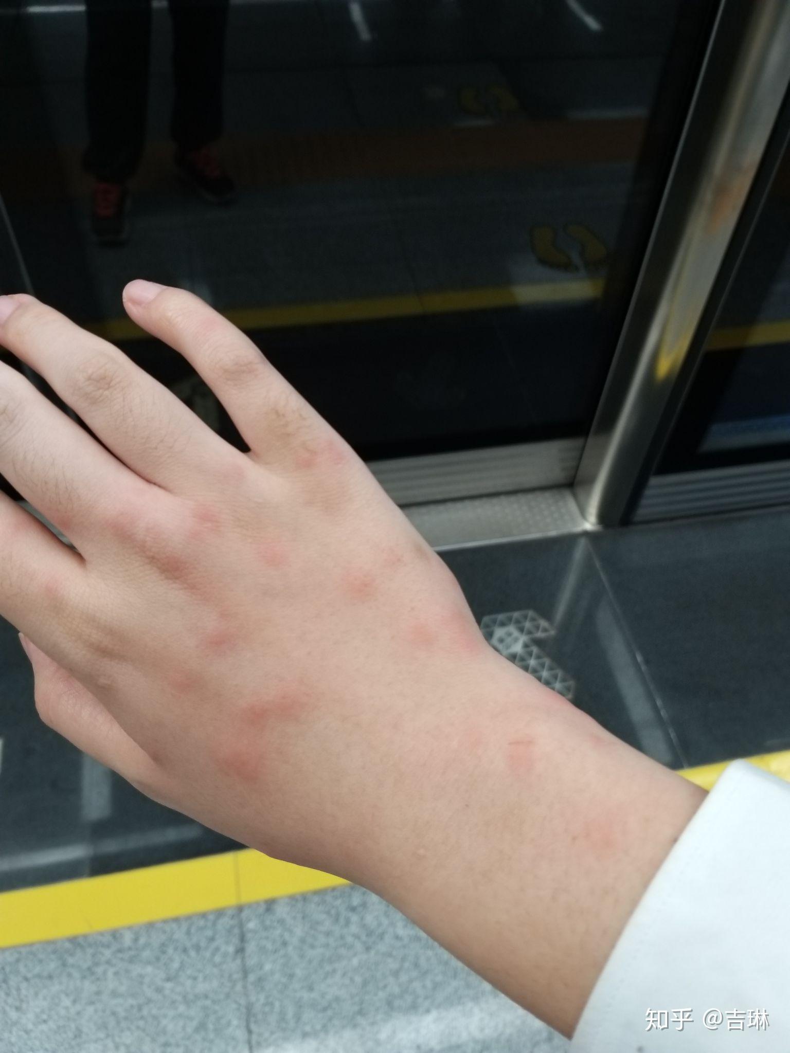 被小咬(一种黑色小飞虫)咬了痛痒难当,怎么破? - 知乎