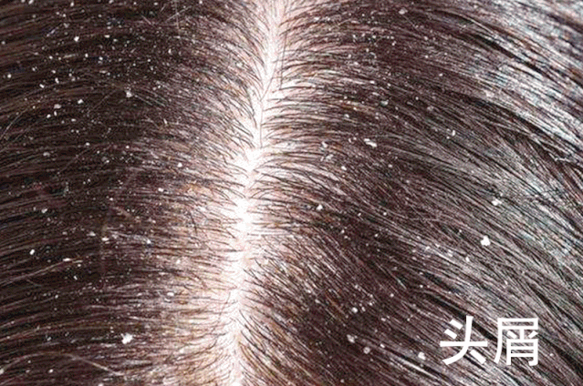 头皮上长“痘”,还有头皮屑?怎么办 - 知乎