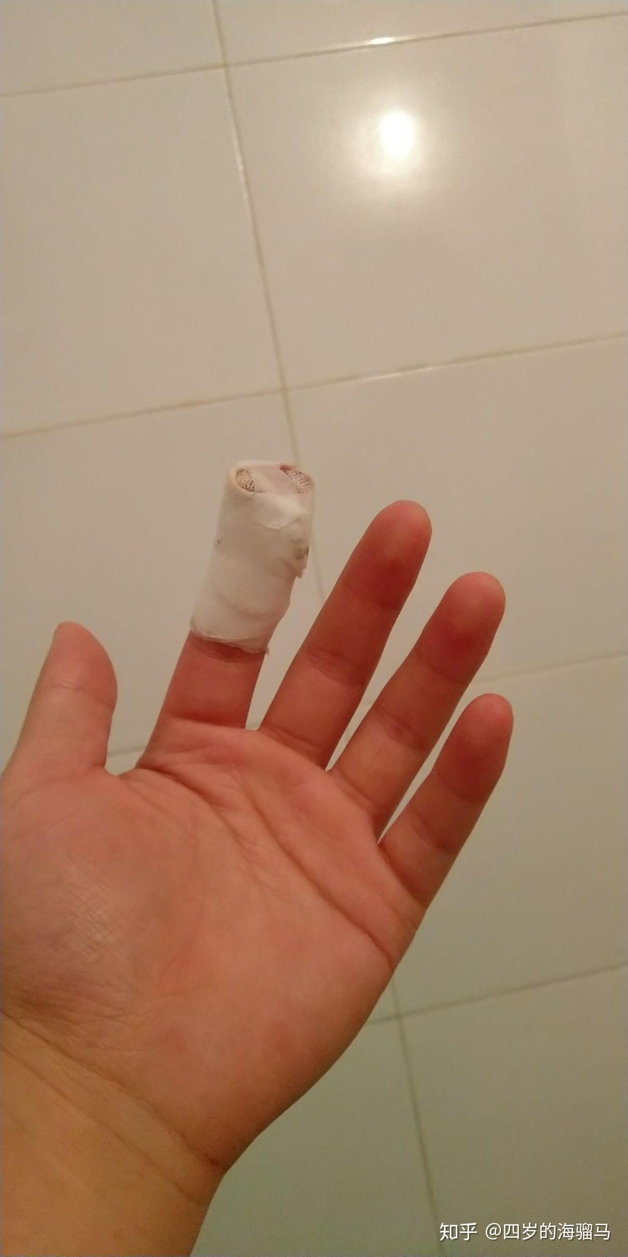 切菜的时候把手指甲切掉了一半血流不止英国的医生只用温水冲了一下就