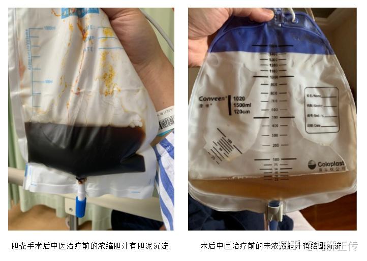 胆汁成分与功能,胆囊形态与结构综述 - 知乎