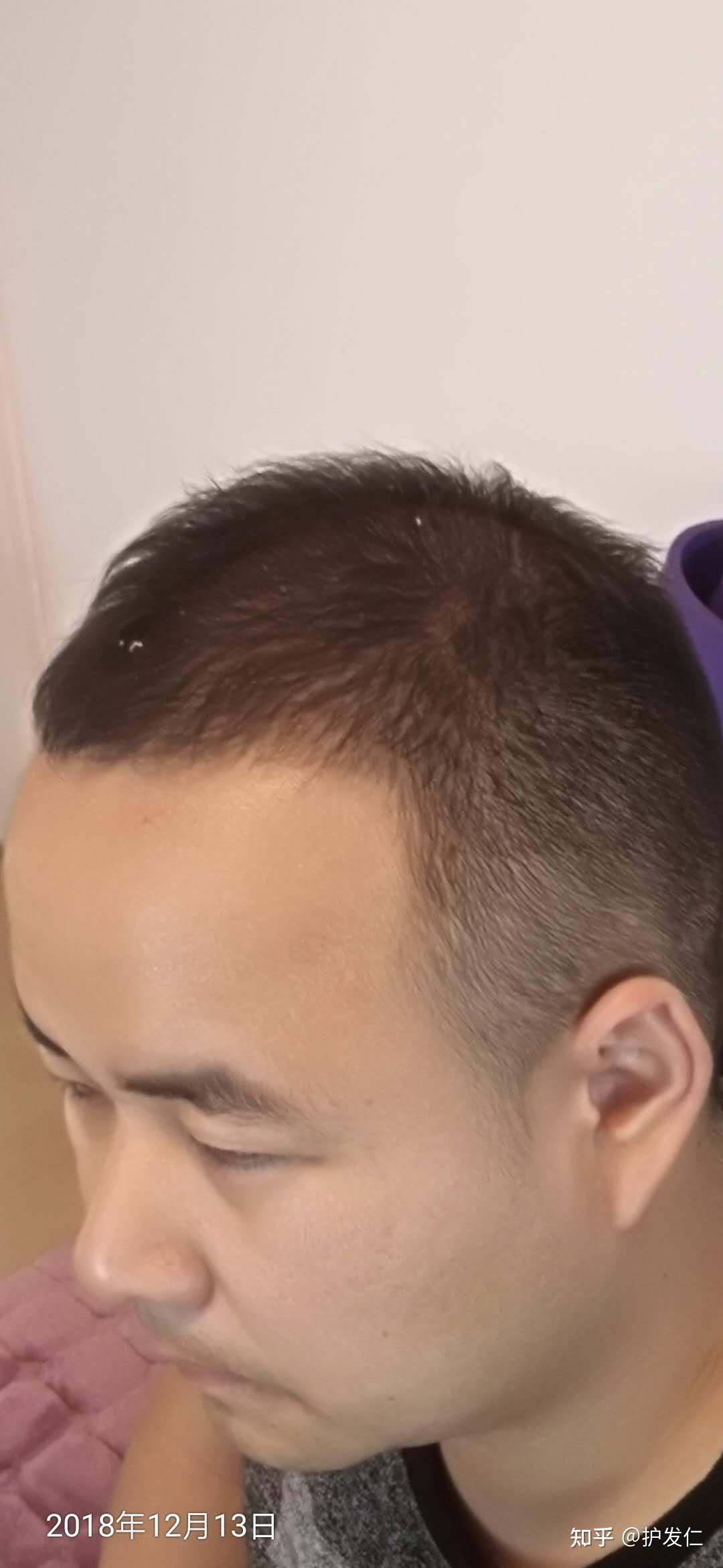 20岁男生这算脱发迹象了吗