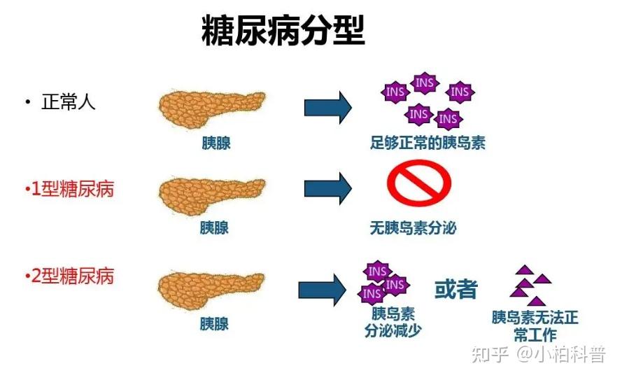 糖尿病如何治疗? - 知乎