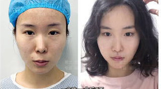 人中缩短 人中窝加深真人案例分享 - 知乎