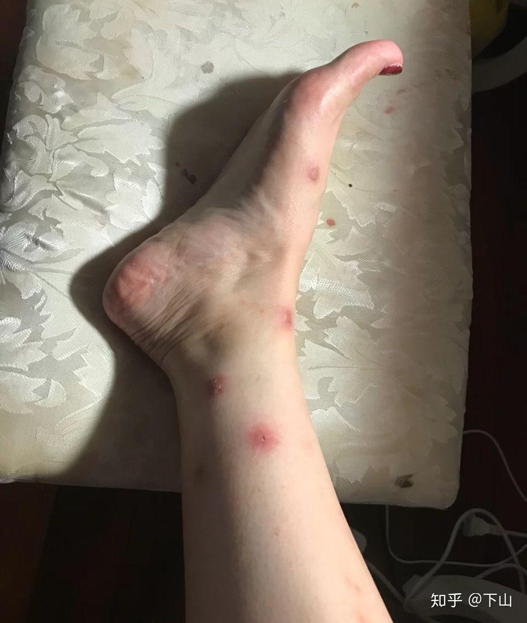 被蚊子咬到崩溃用什么表情包骂它