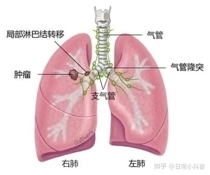 中央型肺癌图片