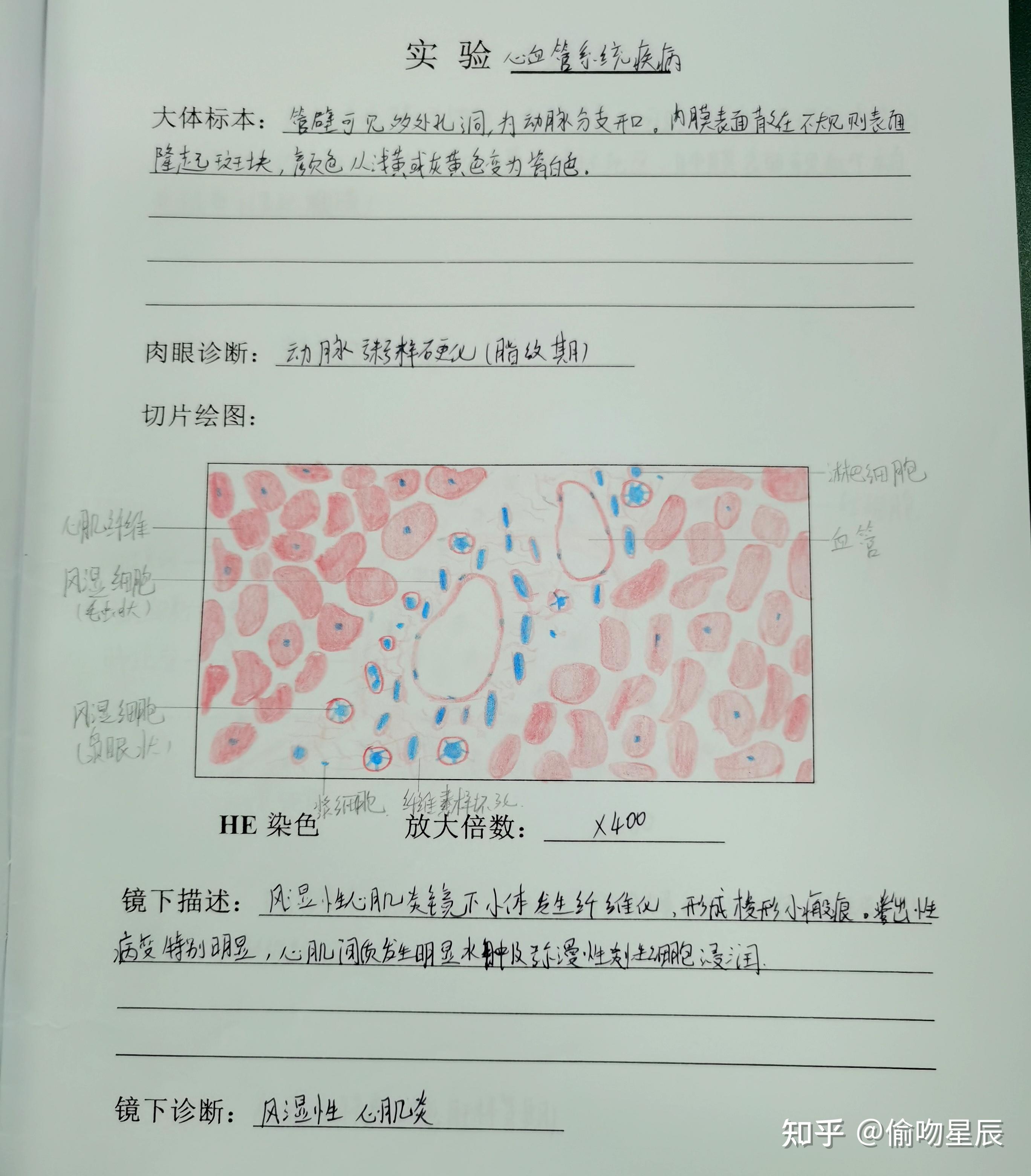 有没有人有病理的结肠腺癌红蓝铅笔手绘图啊? - 知乎