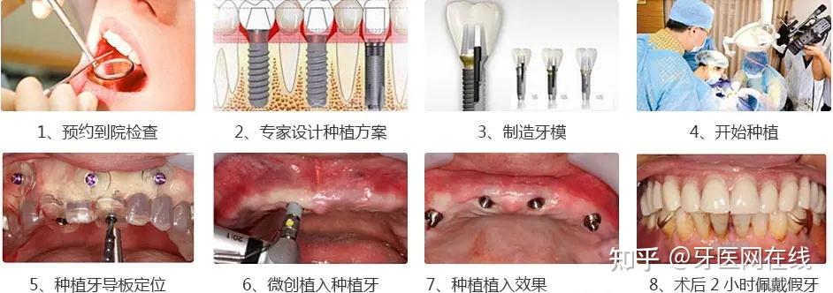 种一颗牙齿一般要多少钱一颗