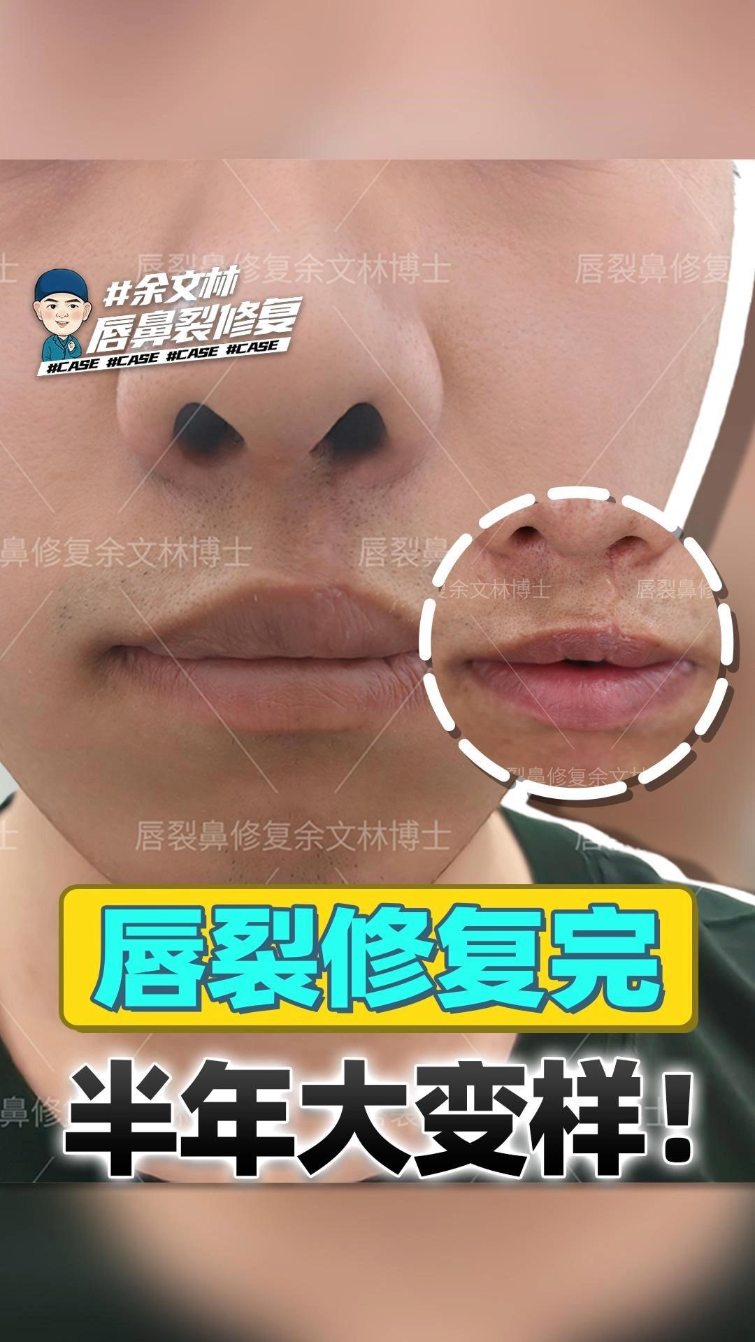 唇裂修复半年大变样