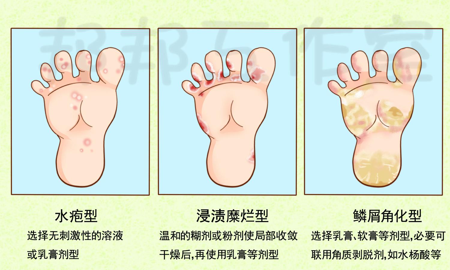 腳氣有哪幾種