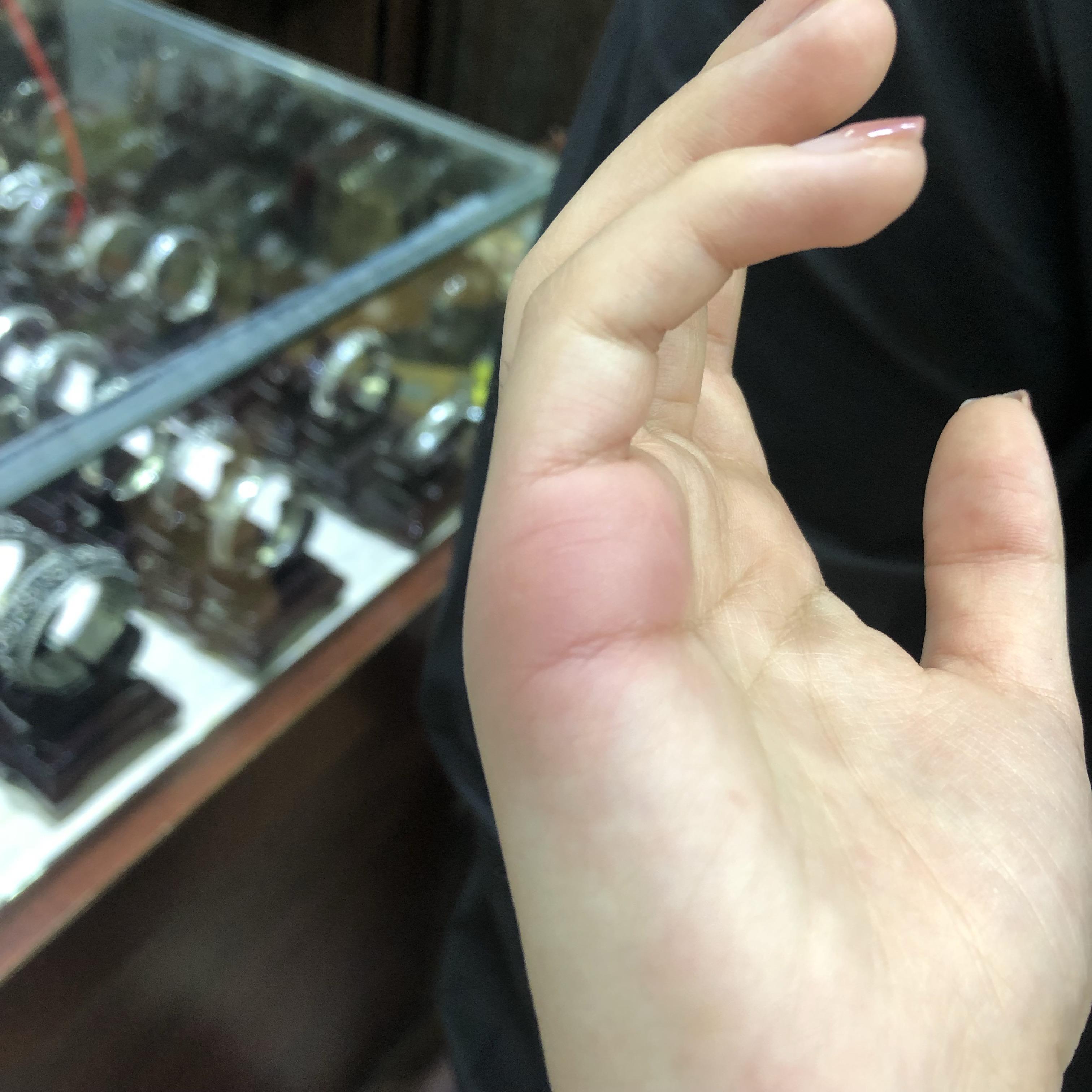 被蜜蜂蛰了的针没有拔出来,要不要紧? - 知乎