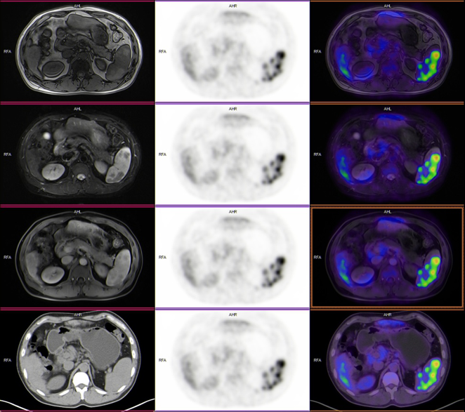 18F-FDG PET/CT-MR多模态诊断结节病累及脾脏一例 - 知乎