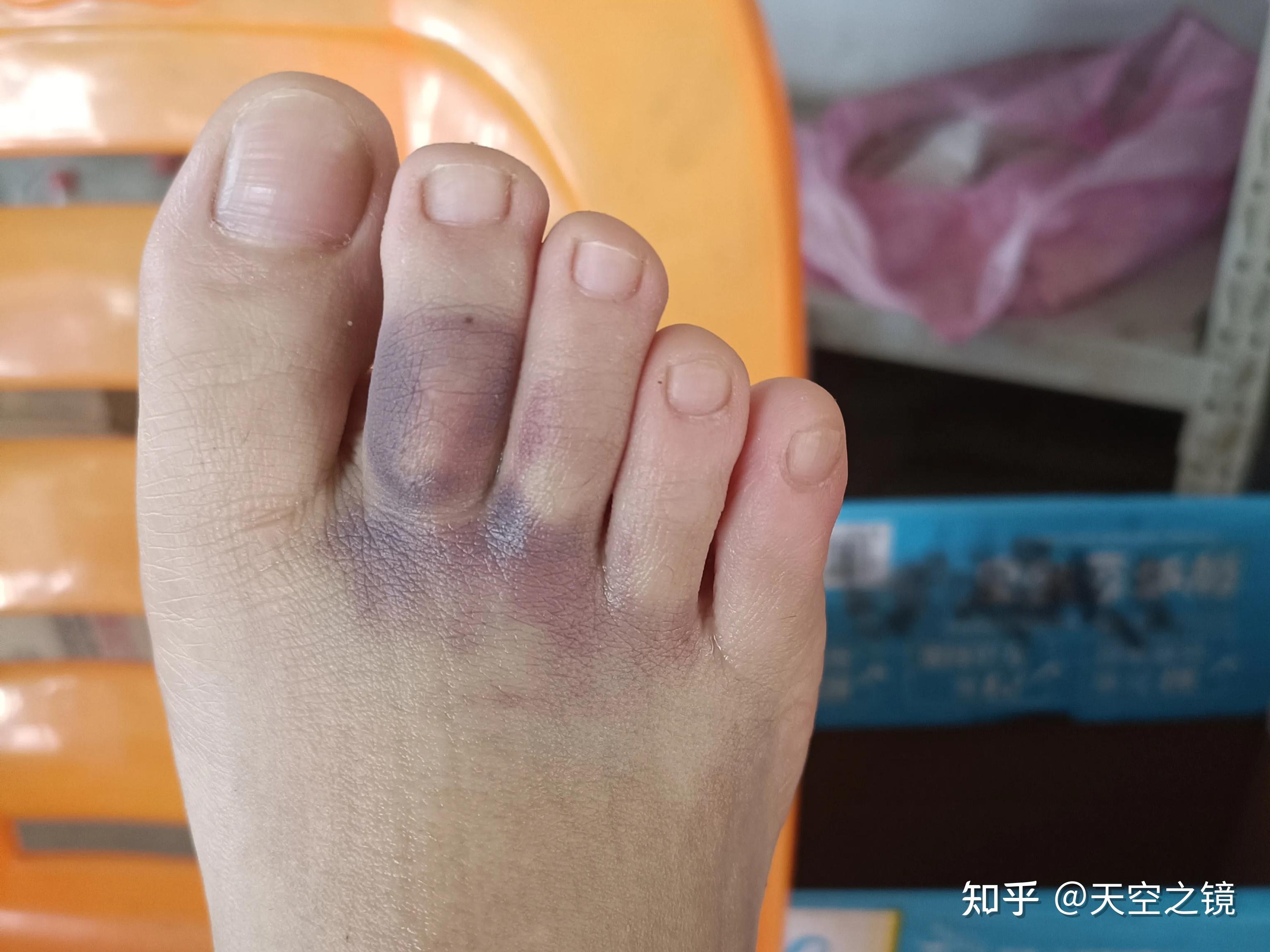 冻脚了用什么药