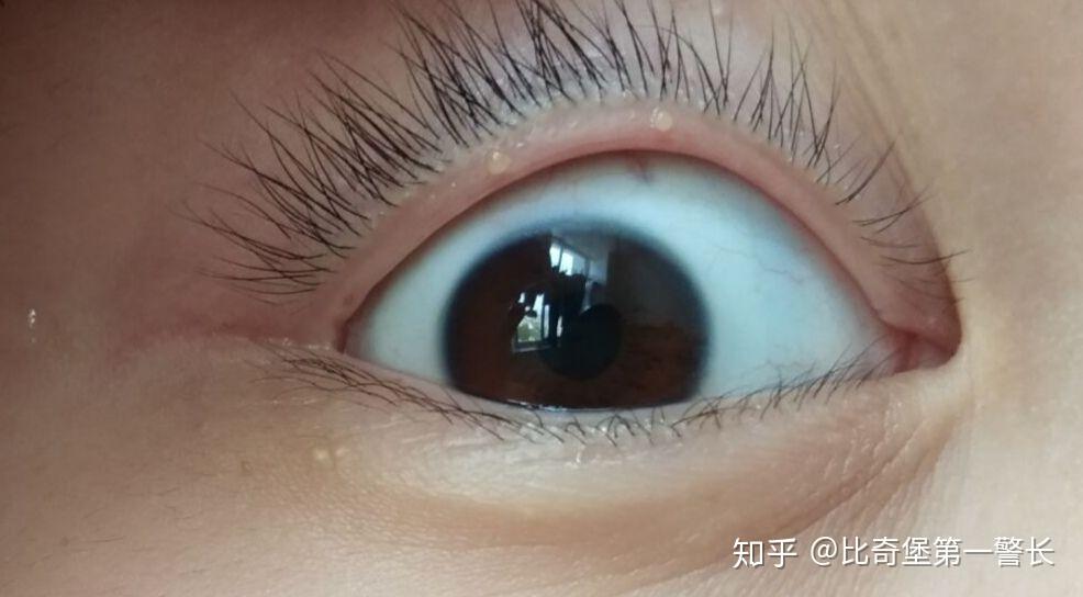 眼睑起了个小泡是怎么了如图