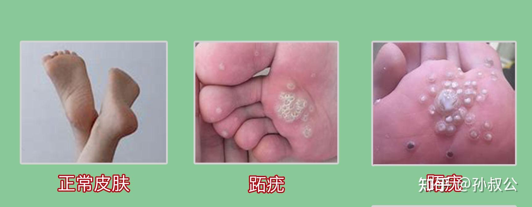 如何判断皮肤上出现的是疣？ - 知乎