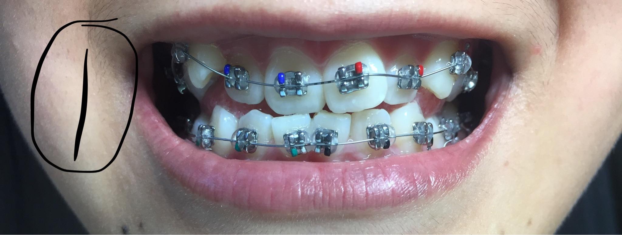 请问可不可以只矫正上牙