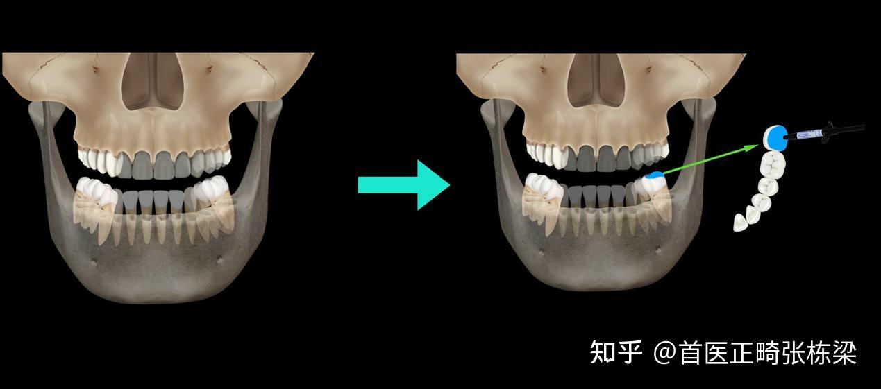 偏颌是怎样一种体验? - 知乎
