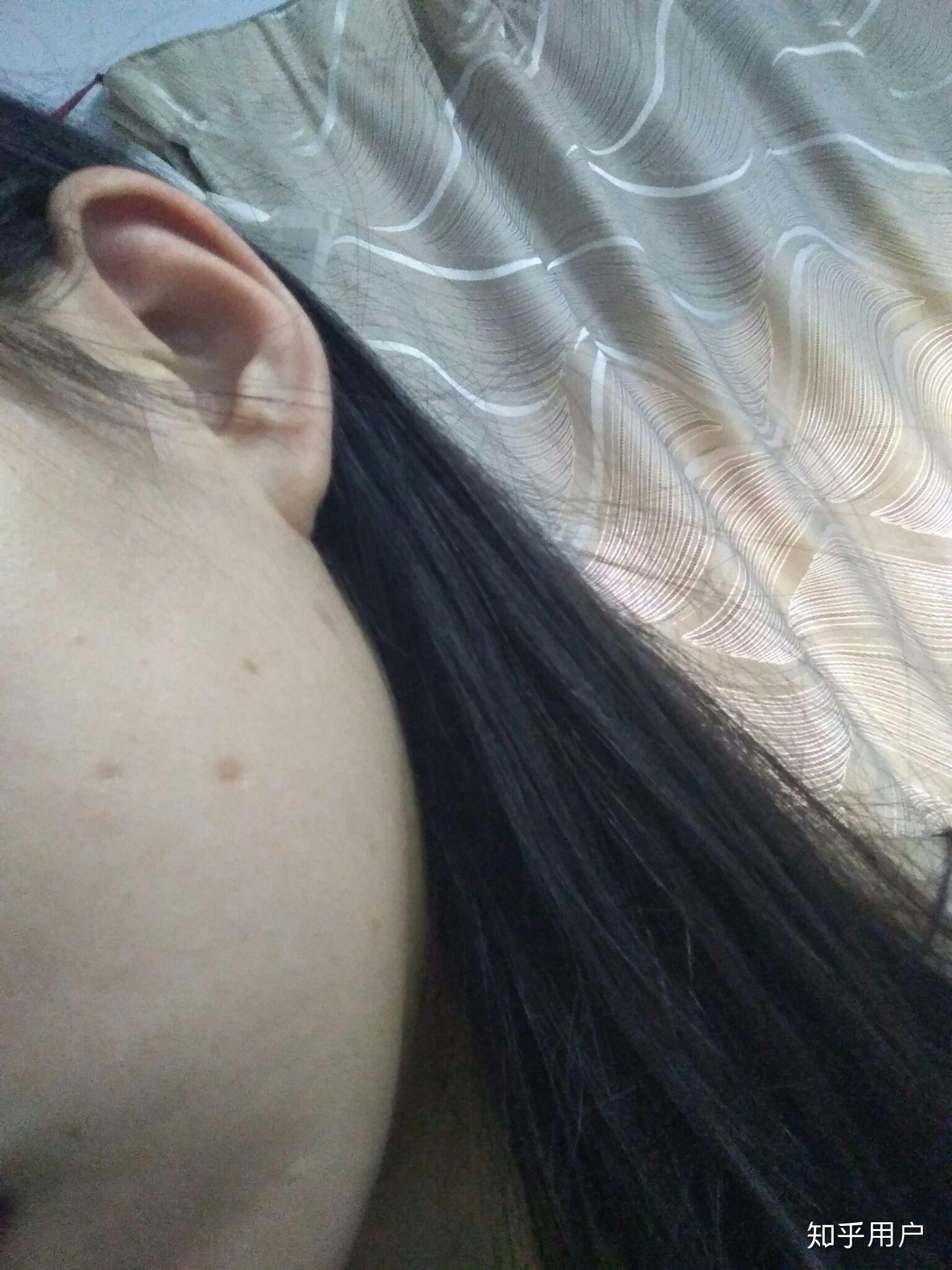 点痣后留下的红坑要多久才能恢复