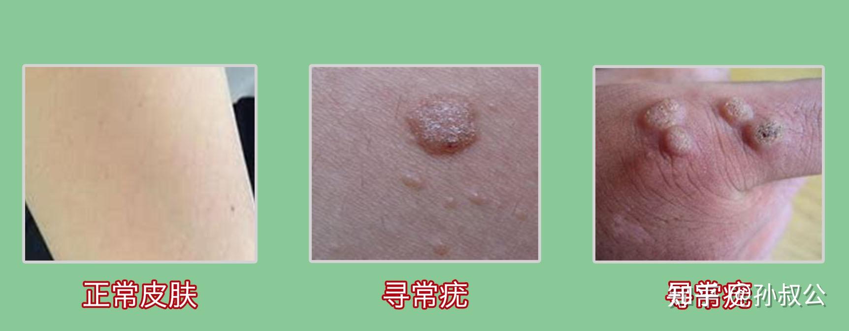如何判断皮肤上出现的是疣? - 知乎