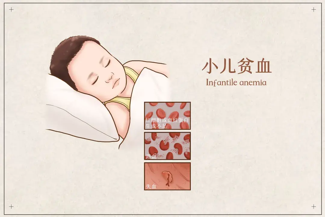 初生到一周岁内的宝宝缺铁性贫血,有什么除了药物性补血的专业建议吗?