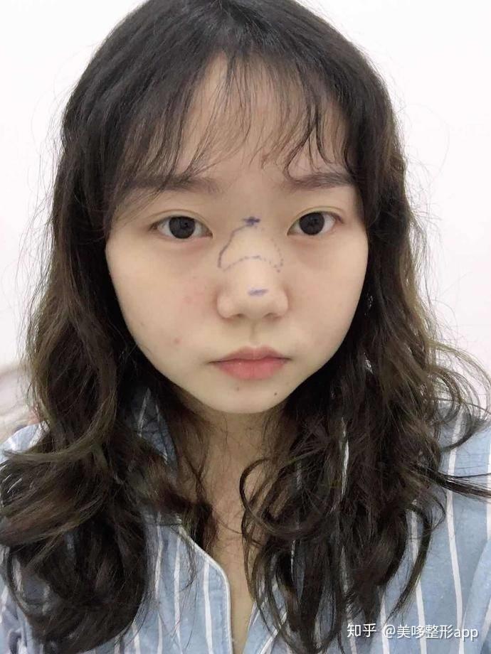 拥有宽鼻翼大鼻头是怎样一种体验