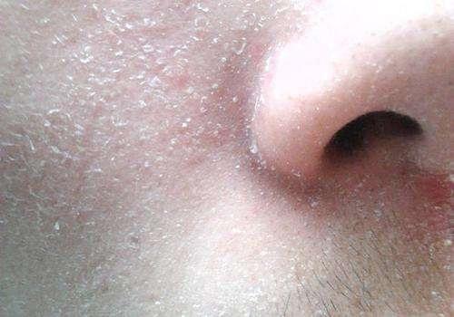 皮肤缺水一般有哪些表象秋冬皮肤干燥脱皮爆皮怎么办