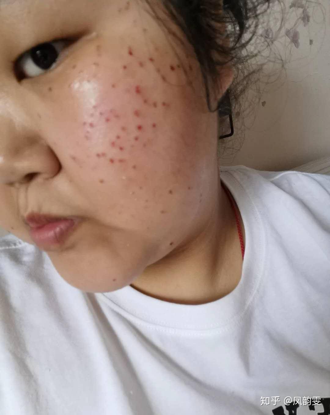 请问面积比较大的扁平疣用激光能够完全消除吗