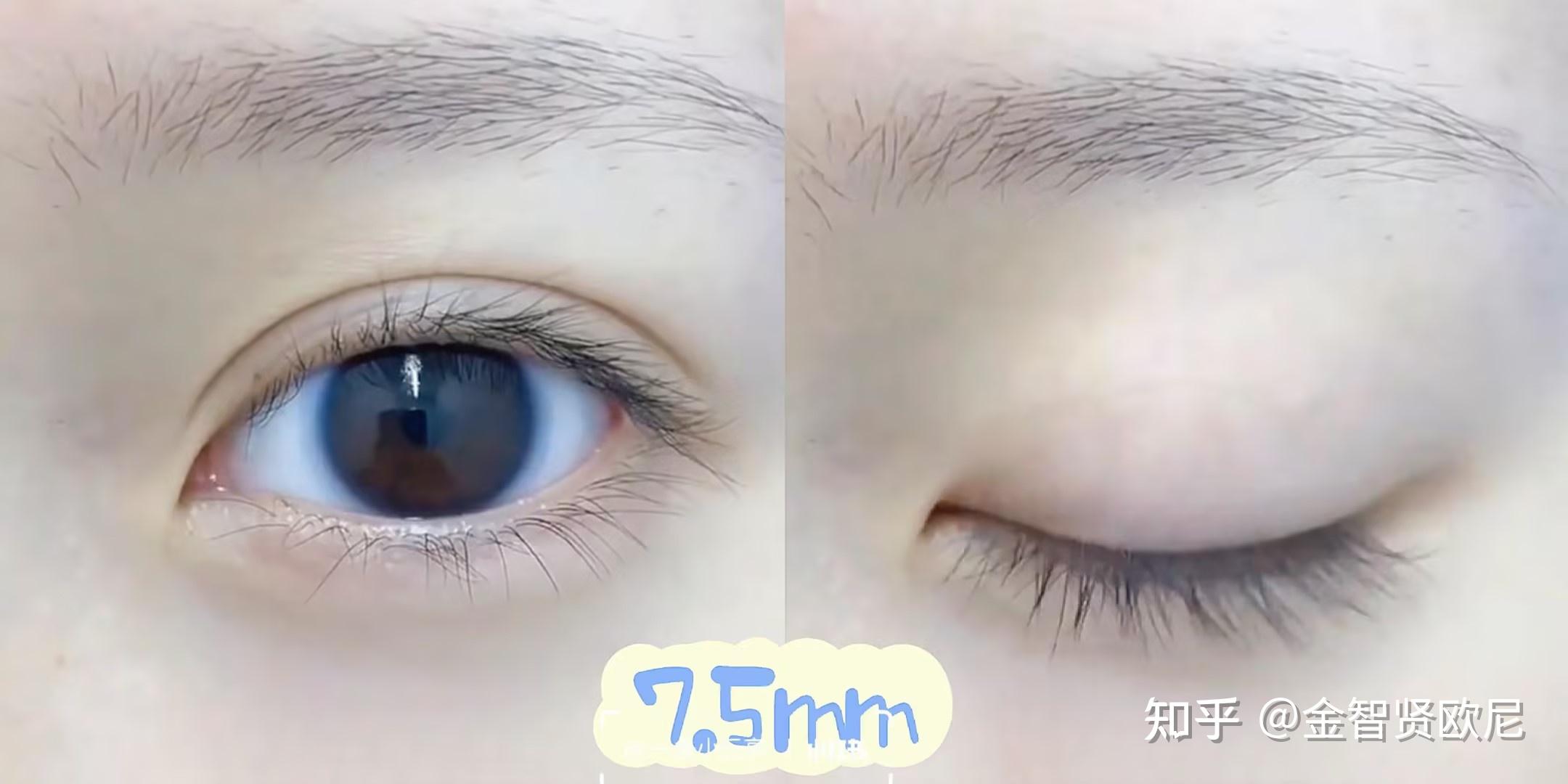 【双眼皮最全攻略】什么类型的双眼皮才适合你?不同术式该怎么选择?(全文干货) - 知乎