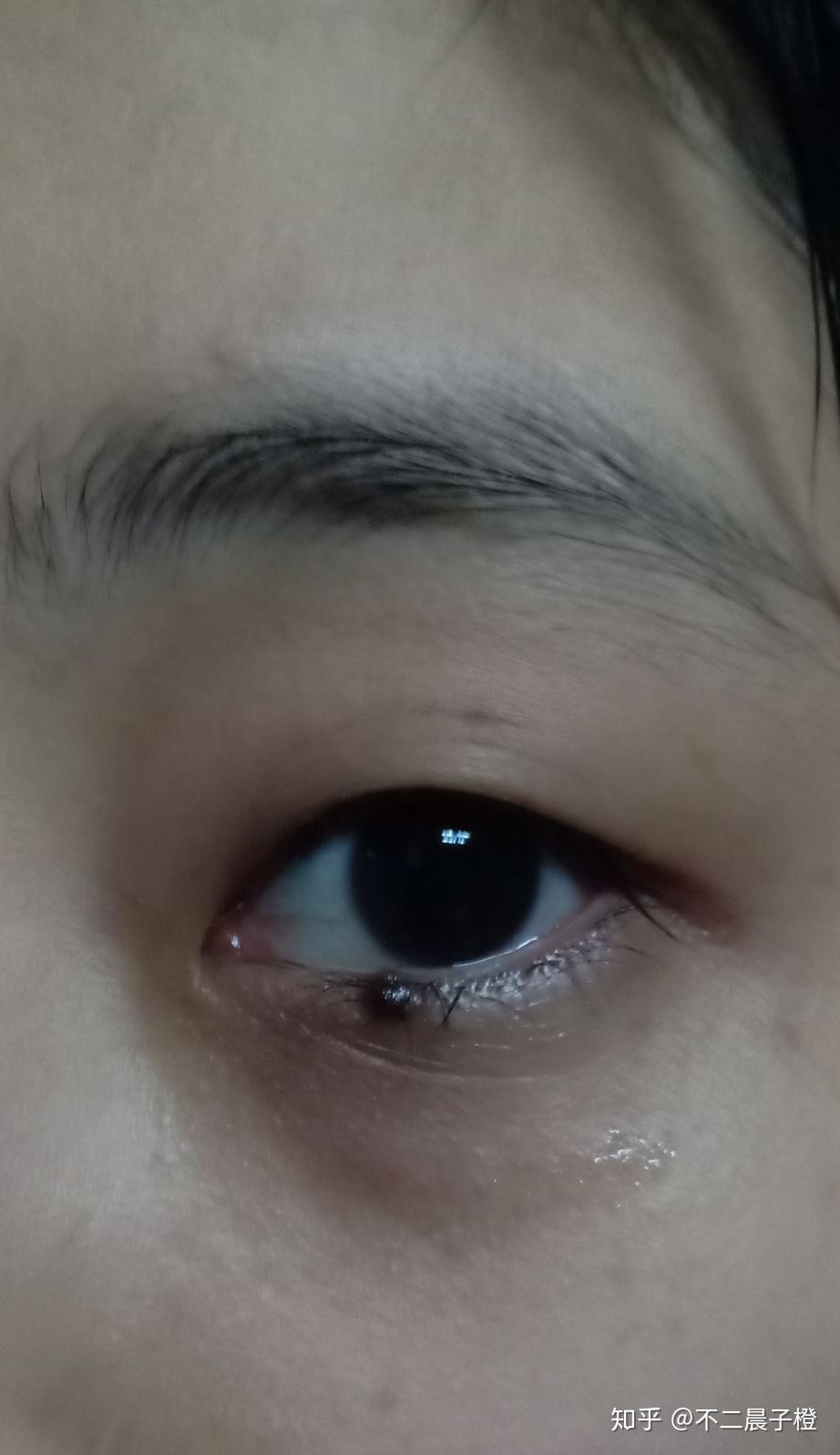 你怎么看待眼下痣