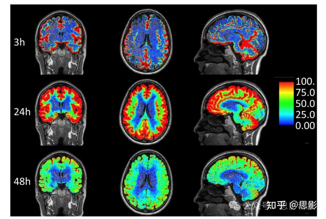 当前对神经液体解剖学、生理学与磁共振成像的理解 - 知乎