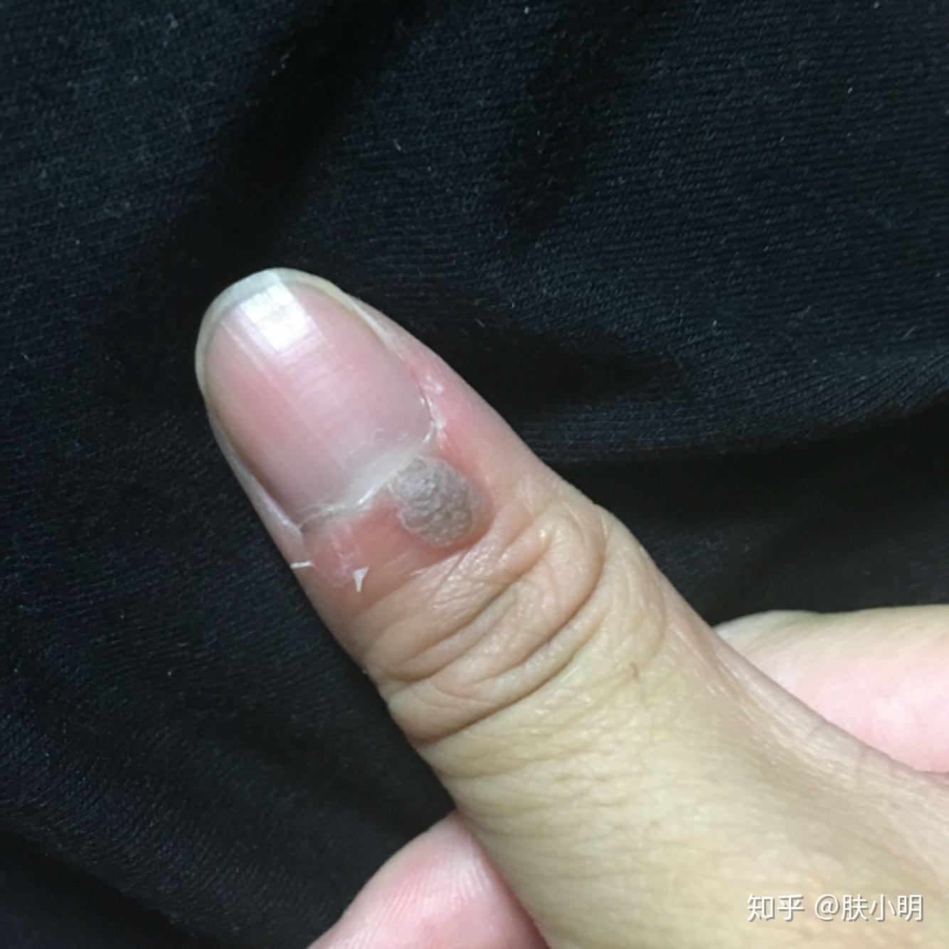 甲周疣最佳治疗方法是什么