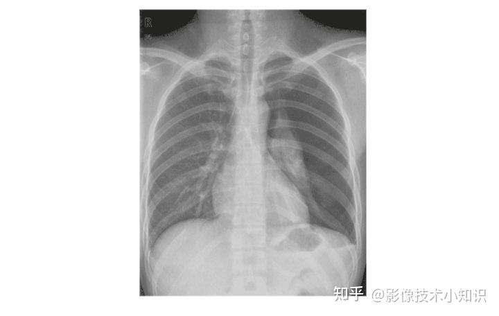 图+影像诊断报告(气胸) - 知乎