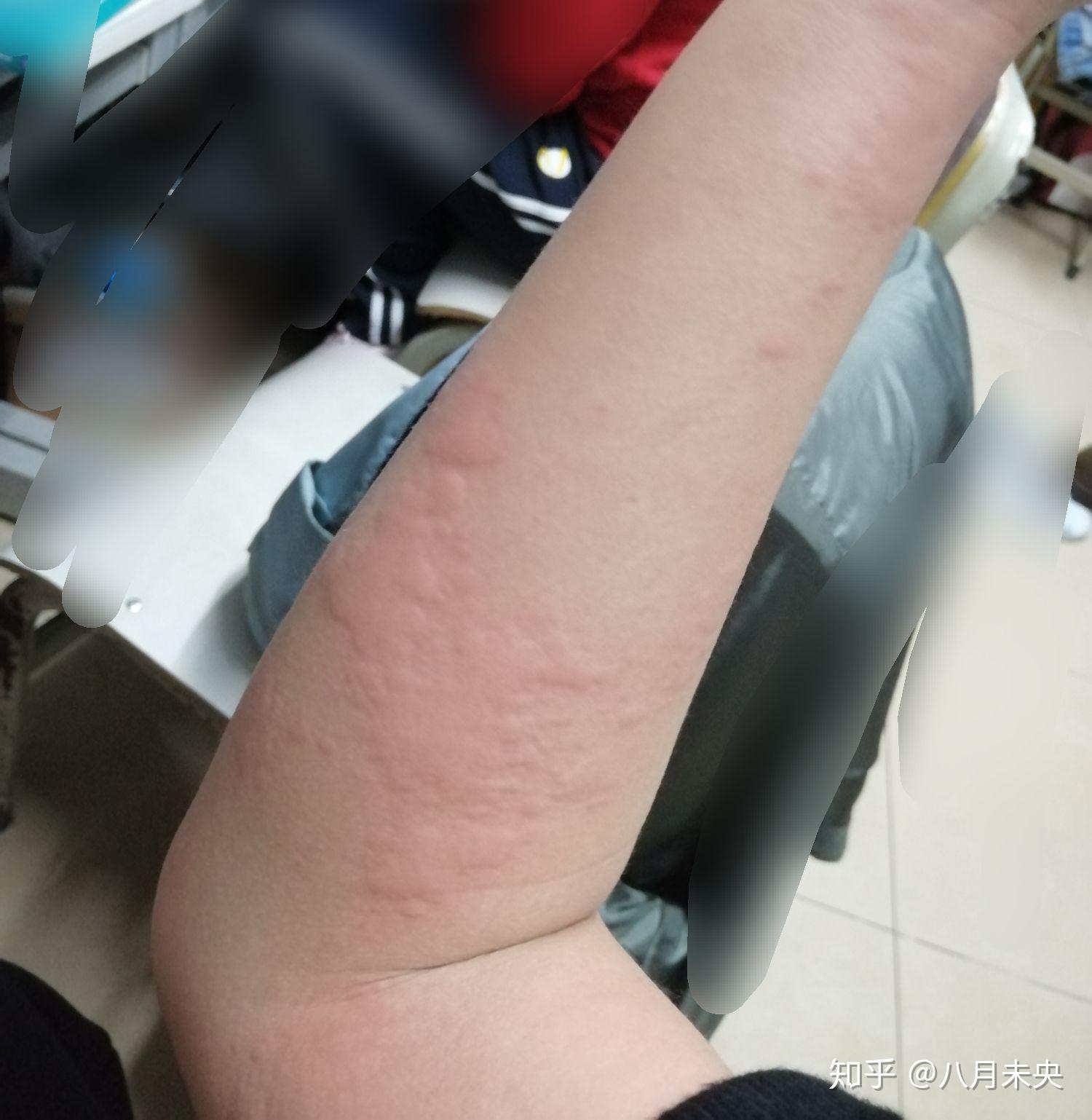 得了荨麻疹是一种怎样的体验? - 知乎