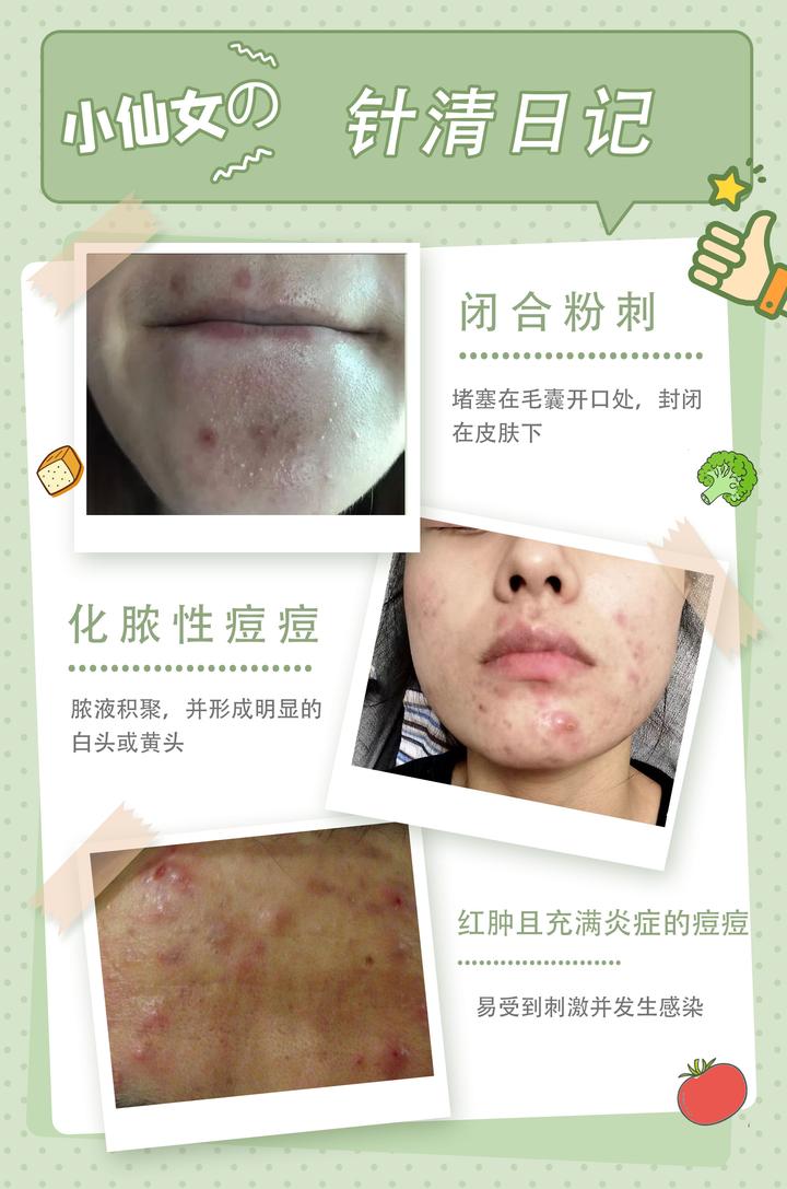 依菲丽水光吧：到底要不要针清呢 针清多久做一次⁉️🔚(一） - 知乎
