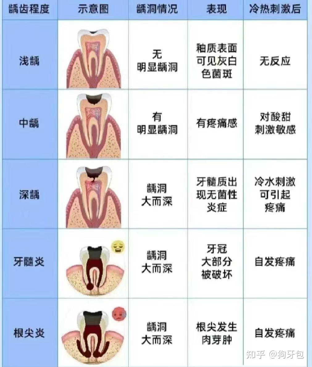 如何区分龋齿和黑色素沉淀？ 知乎