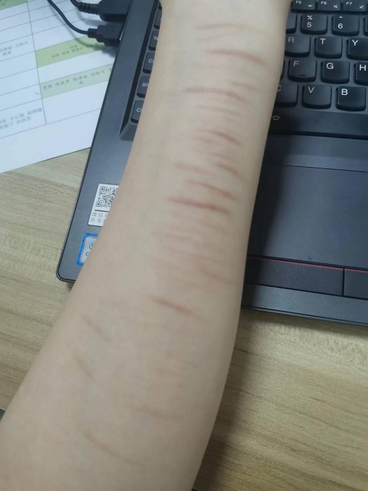抑郁症患者夏天穿短袖,自残痕迹直接露出,他心理是怎么想的?