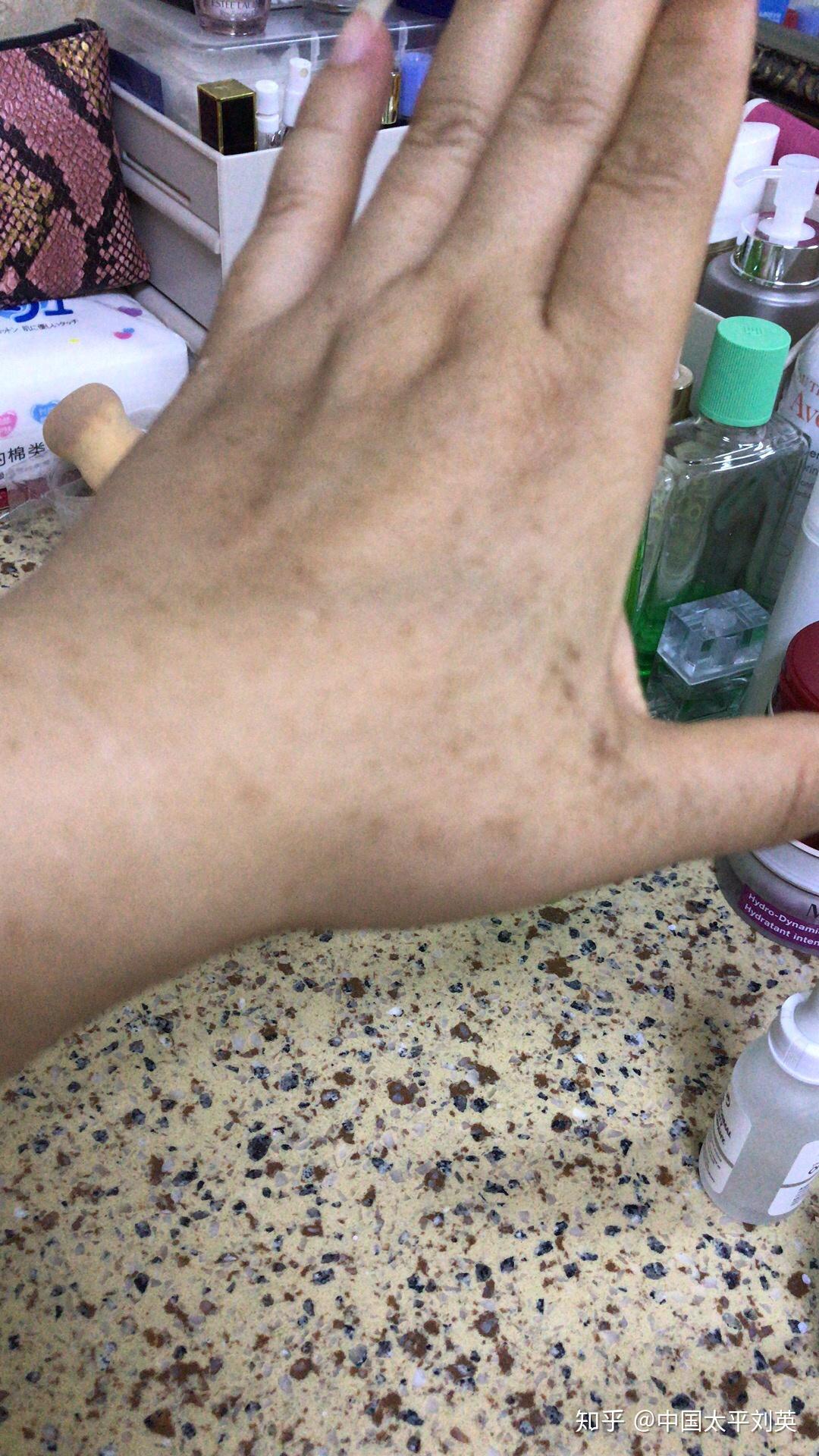 手上长了一些像斑一样的东西到底是什么呢