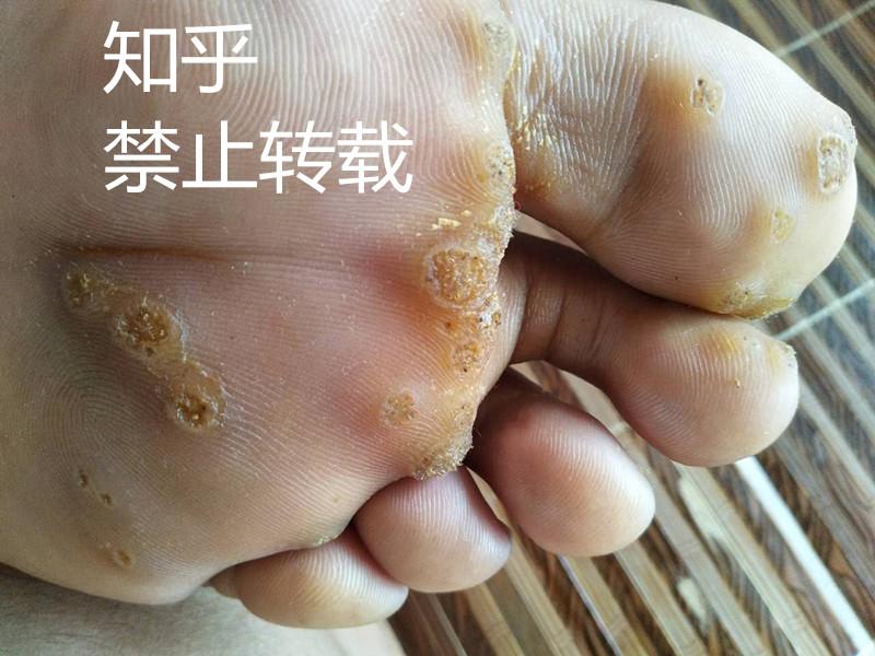 足底疣正确根治方法
