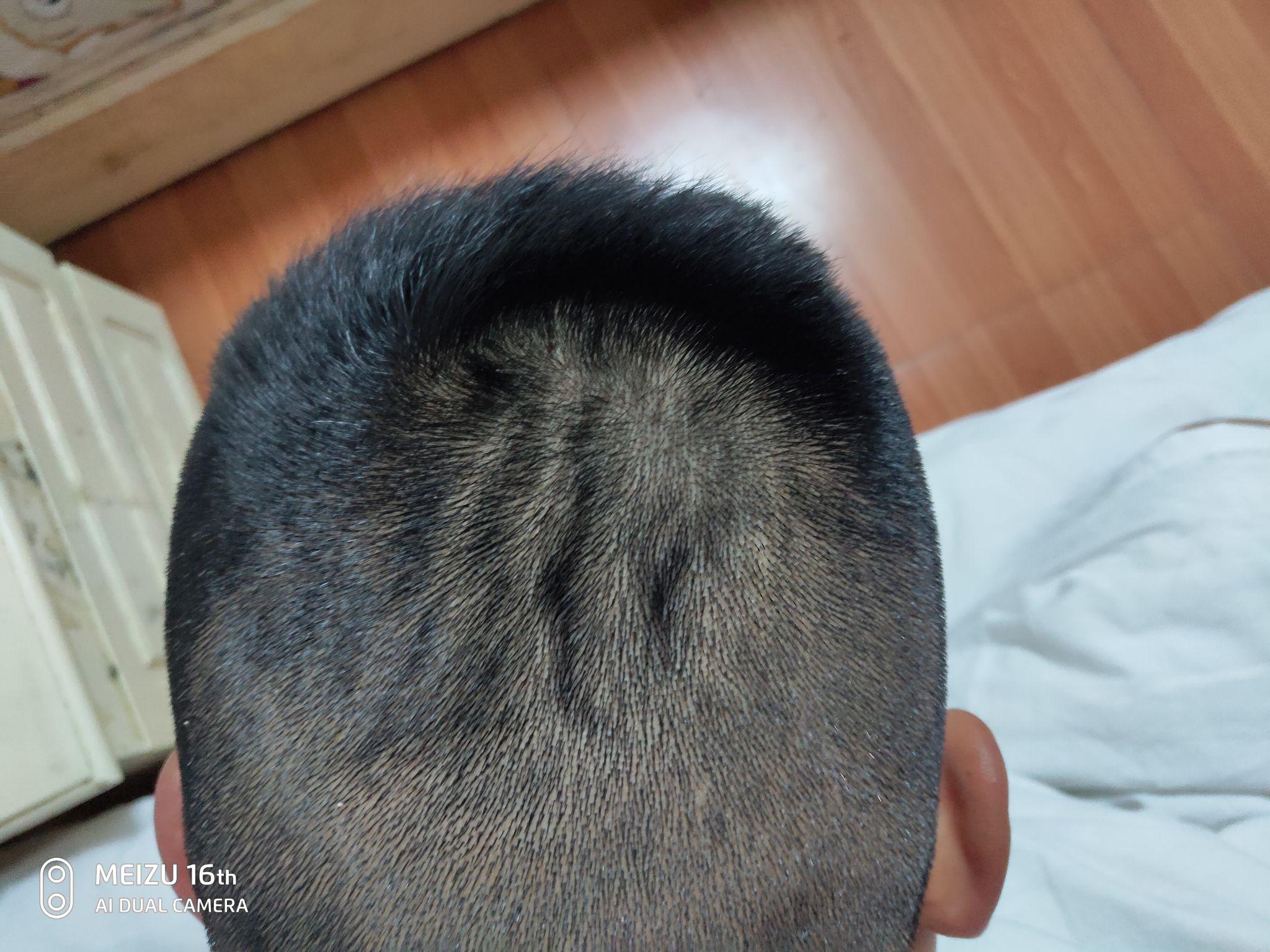 头皮有好多沟怎么回事能治疗吗