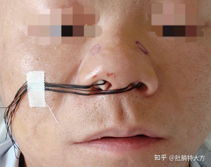鼻中隔偏曲手术风险图片