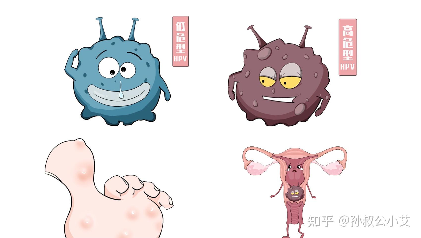 脚上长了跖疣如果去接种hpv疫苗会好吗