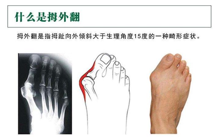 科普| 拇外翻的发生与表现 - 知乎