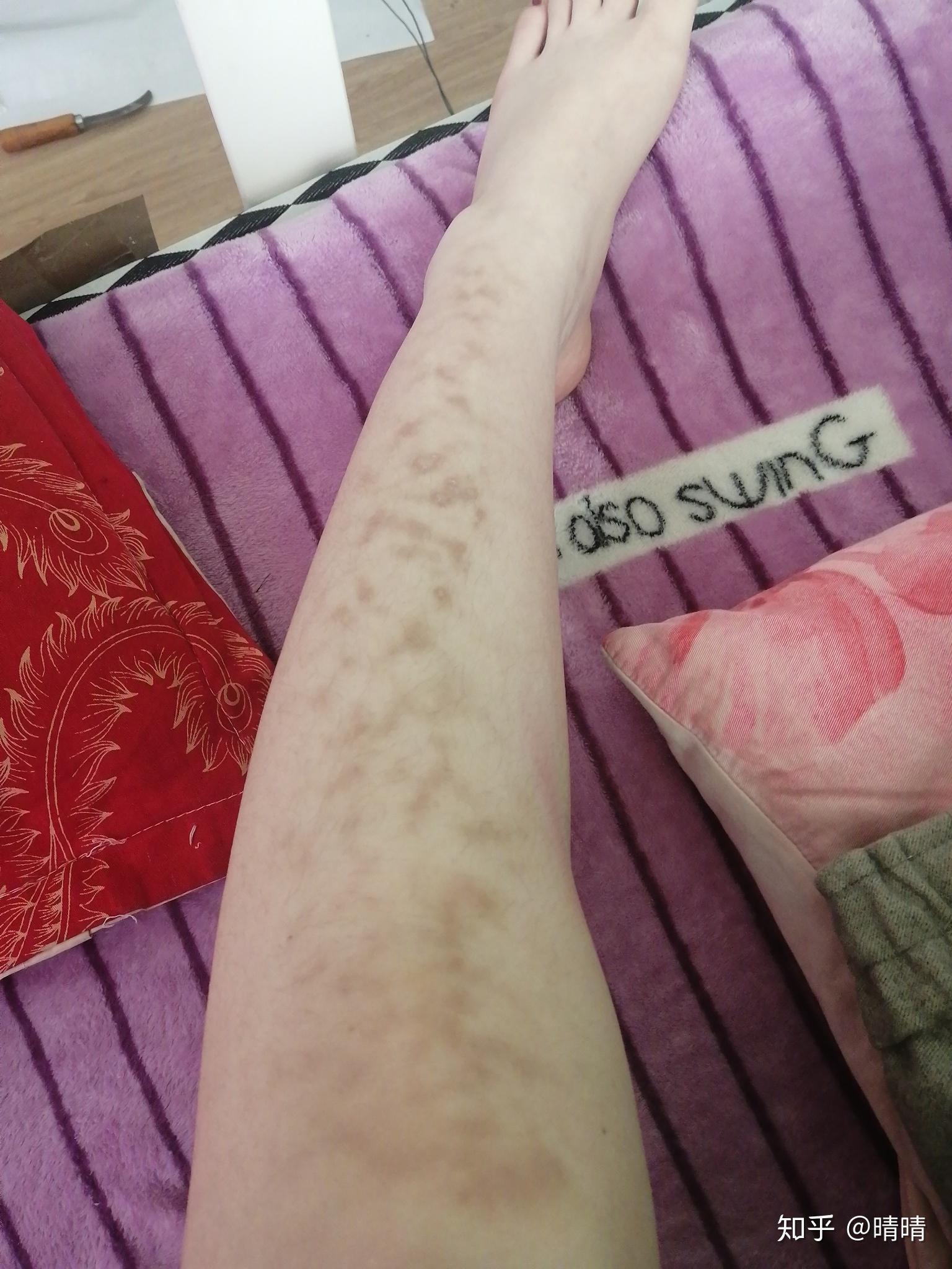 小太阳取暖器烤的时候离的太近腿部大片皮肤出现蜘蛛网状的红斑怎么办