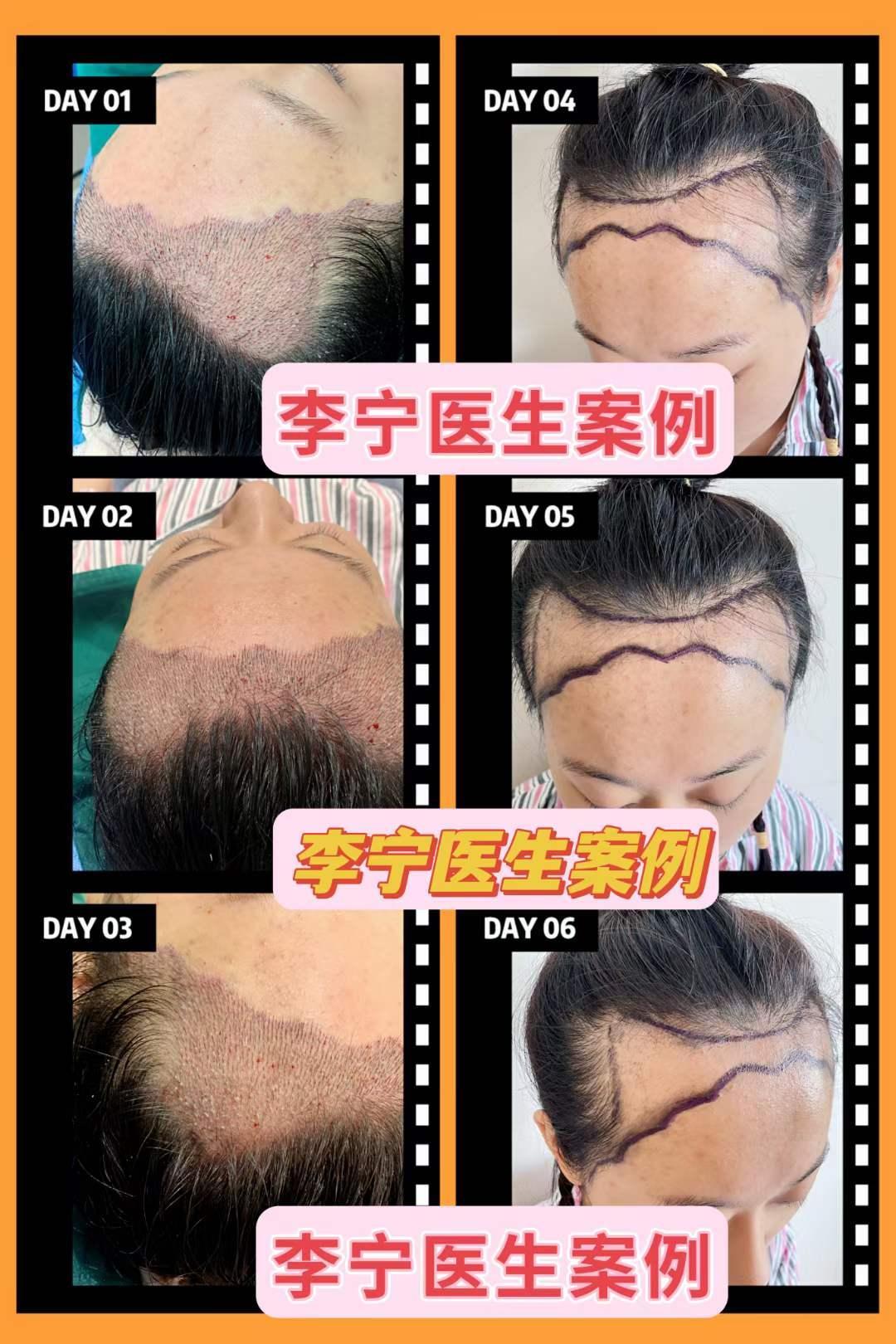 植发后头发存活多久正常(植发后头发存活多久正常生长)