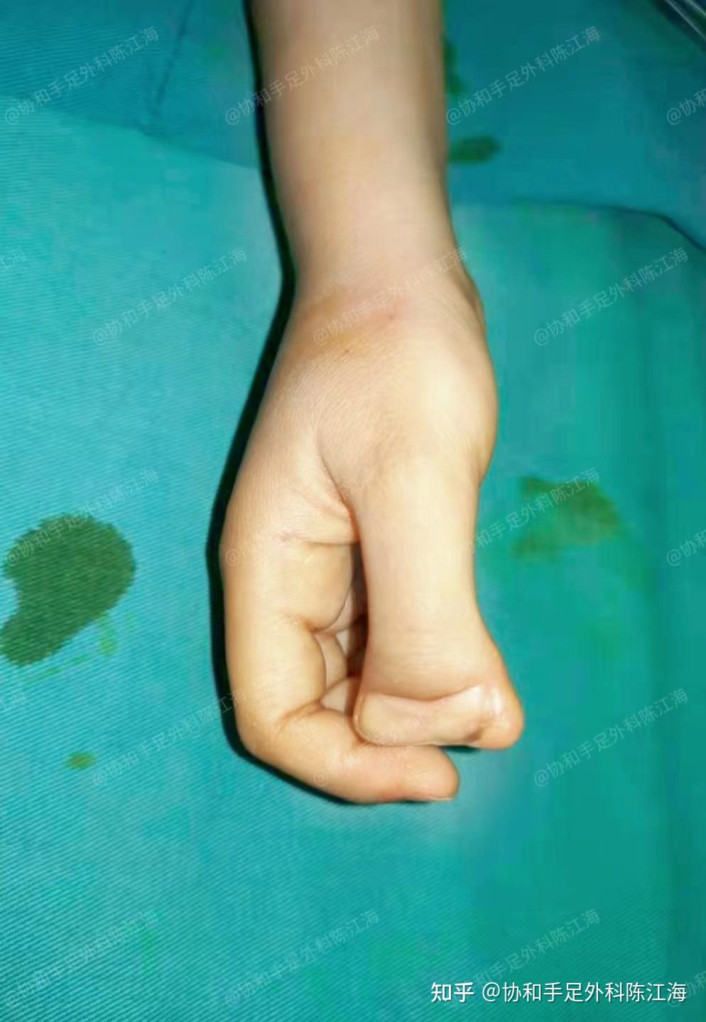 婴幼儿六指哪家医院做的手术好? - 知乎