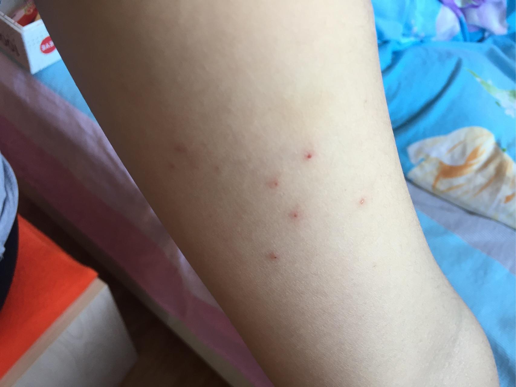 人被猫癣传染的治疗经验