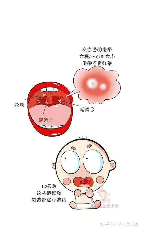 疱疹性咽炎的症状是什么