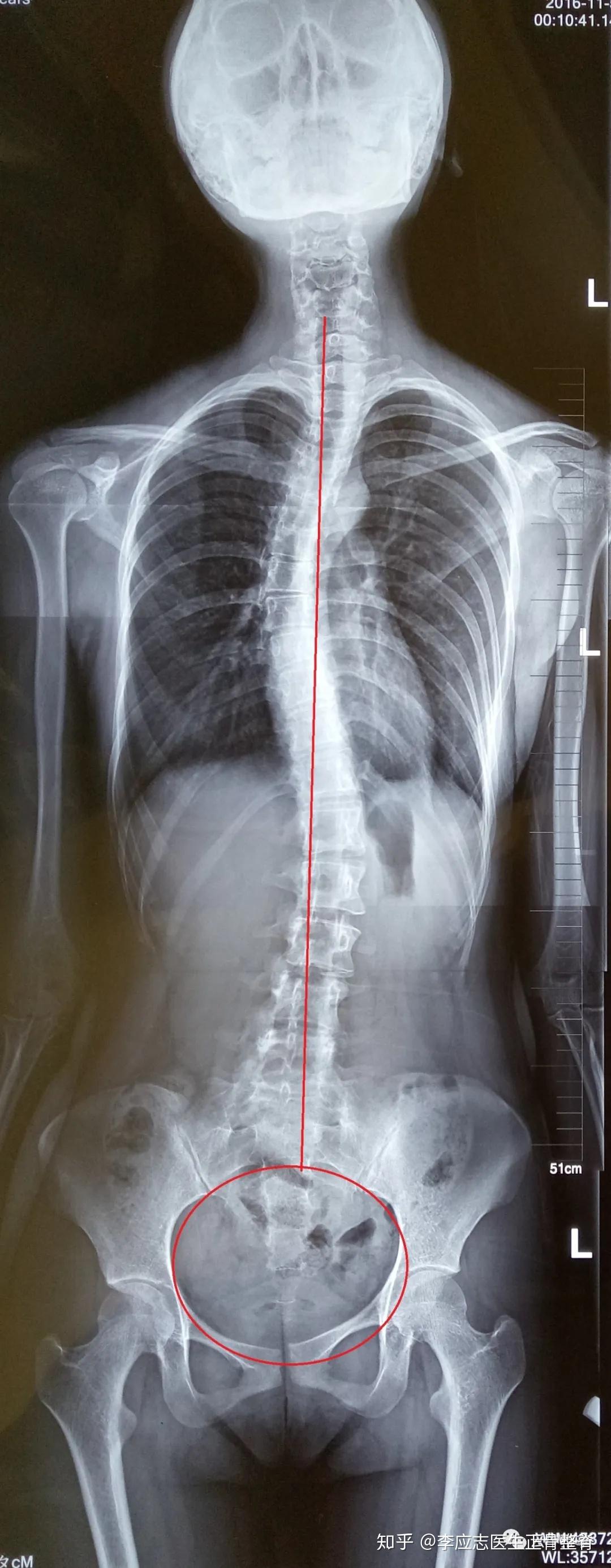 骶髂关节错位的科普
